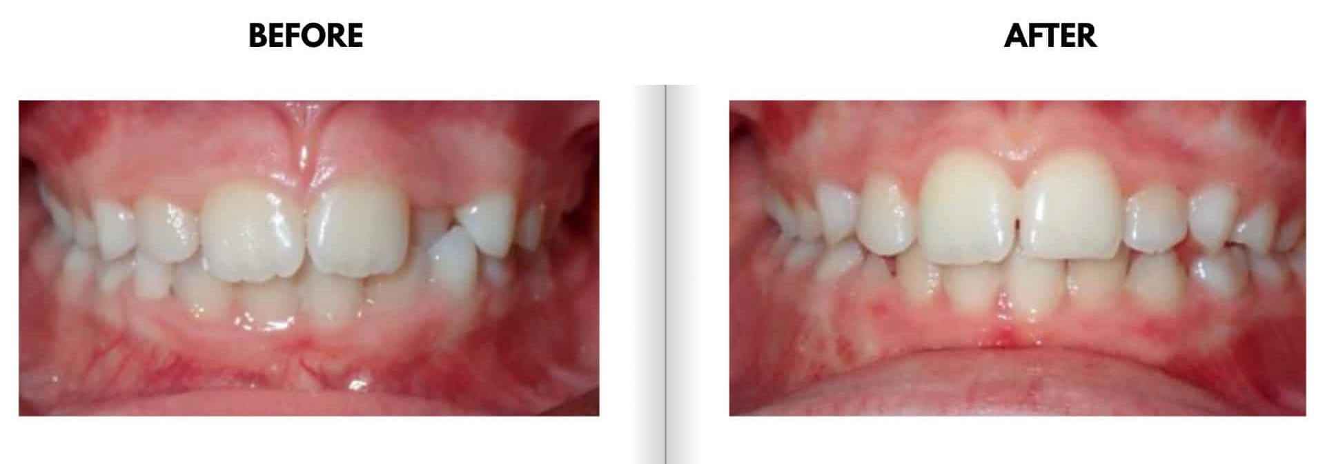 Before and after orthodontic treatment photos showing correction of mixed dentition with a partial anterior crossbite using a removable appliance, resulting in improved bite alignment for Danielle at Griffin Orthodontics, Vernon, CT 06066.