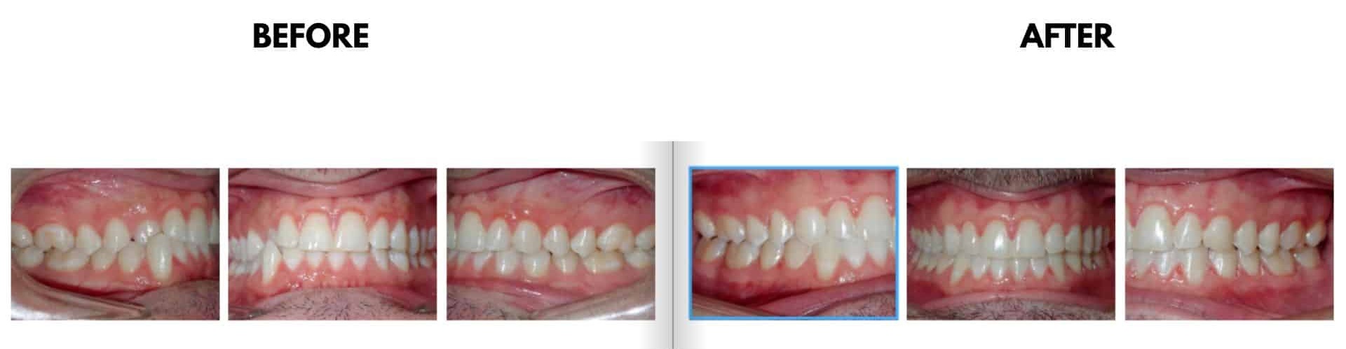Before and after orthodontic treatment photos showing correction of a deep bite and partial anterior crossbite treated with aligners, resulting in improved bite alignment for Anthony at Griffin Orthodontics, Vernon, CT 06066.