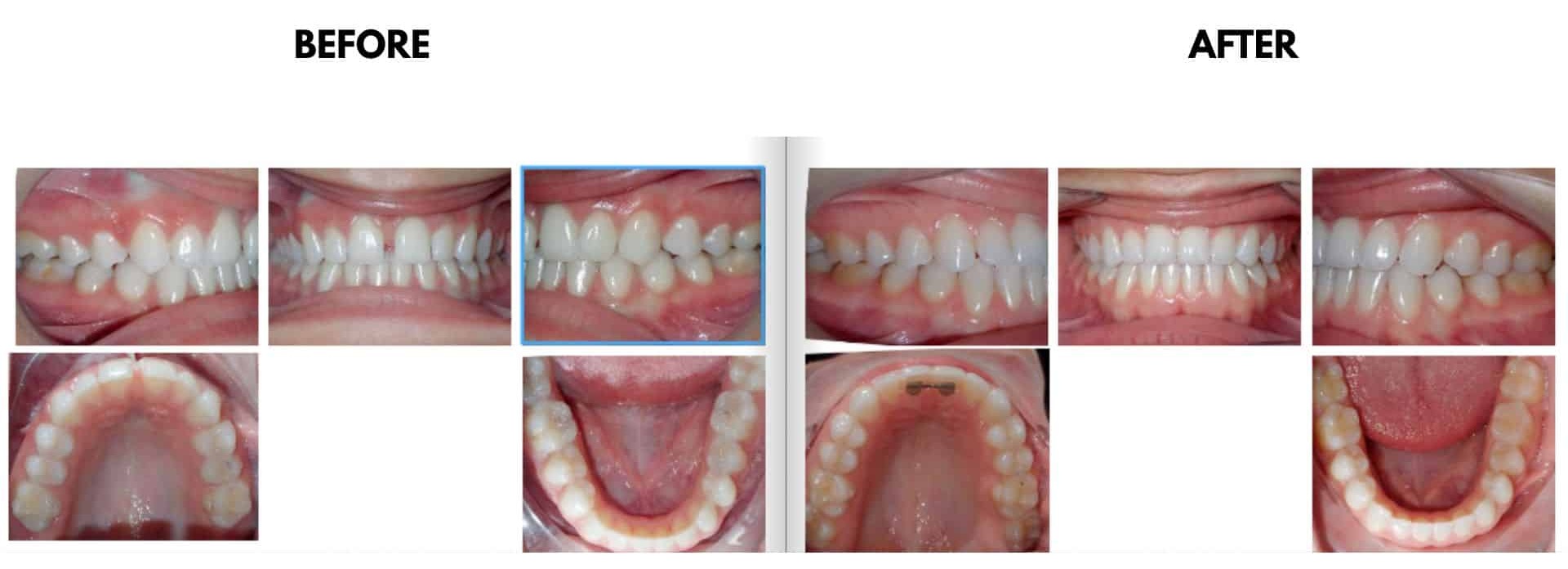 Before and after orthodontic treatment photos showing correction of a moderate deep bite and diastema treated with braces, resulting in improved bite alignment and spacing for Miriam at Griffin Orthodontics, Vernon, CT 06066.